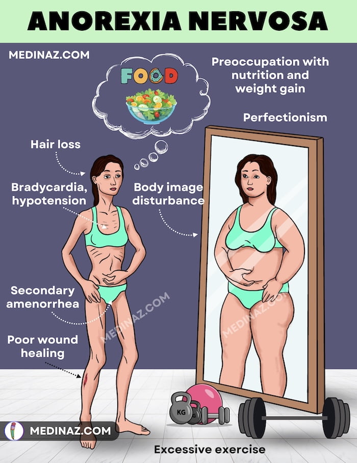 Anorexia nervosa visual mnemonic