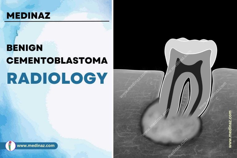 Benign Cementoblastoma Radiology Notes