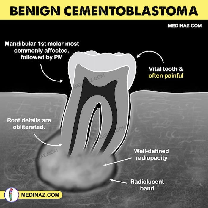 Benign Cementoblastoma Radiology