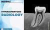 Hypercementosis Radiology: Dental Notes