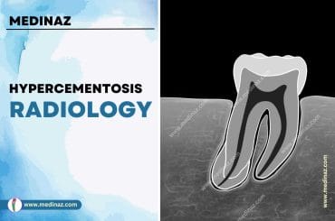 Hypercementosis Radiology