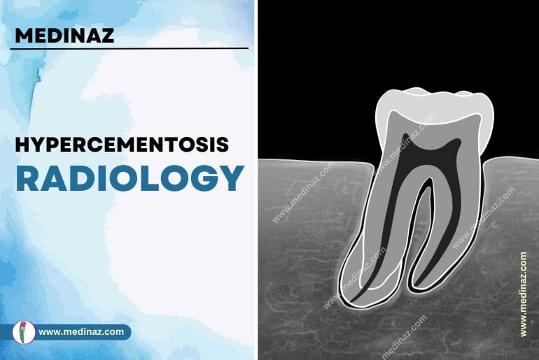 Hypercementosis Radiology