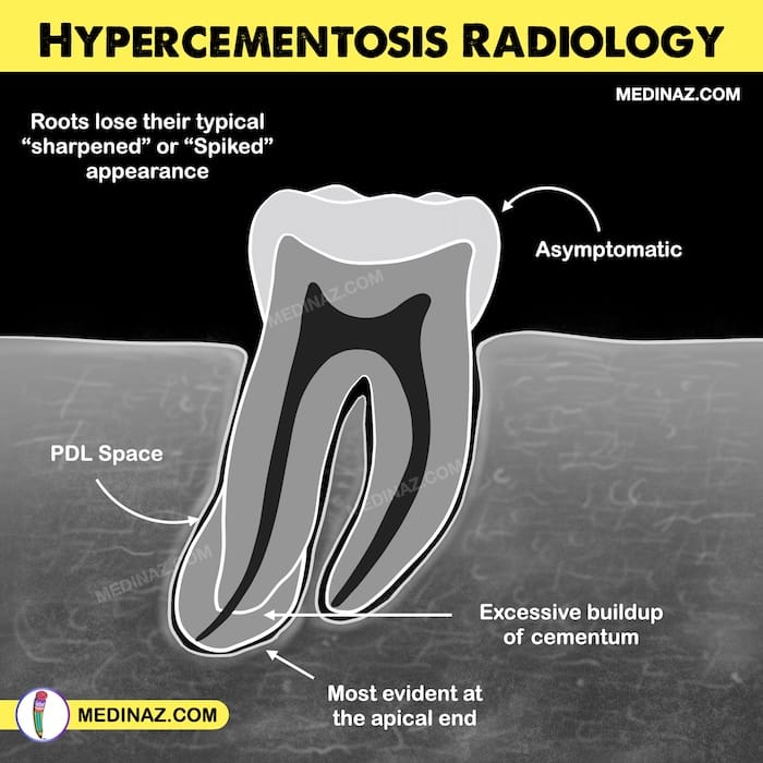 Hypercementosis Radiology Illustration