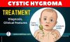 Cystic Hygroma Treatment – All You Need to Know