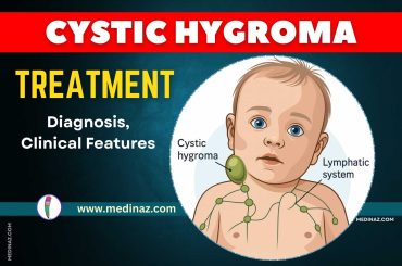 Cystic Hygroma Treatment