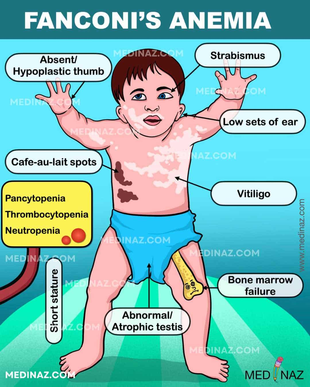 Fanconi Anemia Symptoms Image